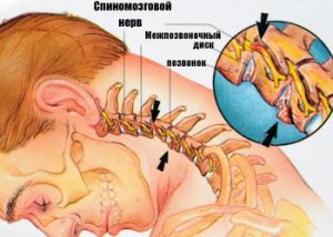 Как да идентифицирате и излекувате нервните болки в гръбначния стълб