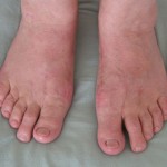 Как да се лекува артрит на крака: причини, признаци, предотвратяване на възпаление в дома
