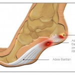 Как да се третира подтискане на крака: как изглежда (снимка), как да се премахне (лечение), симптоми и профилактика