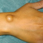 Хигрома на китката на ръката: причини, симптоми (признаци), лечение на китката
