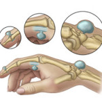 Hygroma на пръста: снимка и лечение на ставата