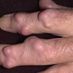 Hygroma на пръста: снимка и лечение на ставата