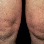Хиперартроза: симптоми и лечение на ставите на коляното