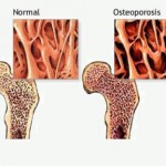 Може ли лечението на остеопорозата: как и какво да лекува болестта