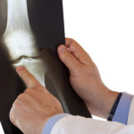 Болест на König: симптоми и лечение на колянната става