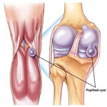 Kick Baker коляно съединение: как да се третира киста под коляното (снимка)