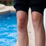 Коляното наранявания: Симптоми и лечение на коляното