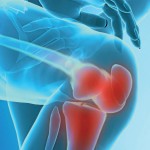 Остеоартрит и артрит на колянната става: симптоми и лечение на заболявания на коляното