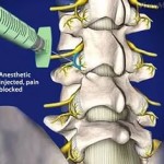 Остеоартрит на аркуталните стави на лумбалния гръбначен стълб
