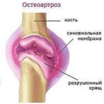 Остеоартрит на колянната става 1 и 2 градуса: лечение на коляното