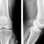 Остеоартрит на колянната става 1 и 2 градуса: лечение на коляното