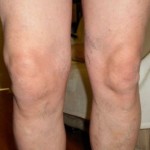 Остеоартрит на колянната става степен 1: симптоми и лечение на коляното