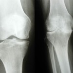 Остеоартрит на колянната става степен 1: симптоми и лечение на коляното