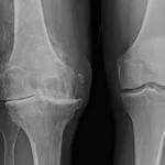 Остеоартрит на колянната става от 4-та степен