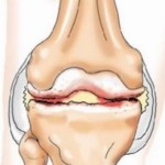 Остеоартрит на коляното: Лечение с конец на коляното