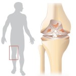 Остеоартрит на коляното: Лечение с конец на коляното