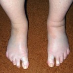 Остеоартрит на долните крайници: симптоми, лечение и снимка на краката
