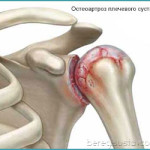 Остеоартроза на раменната става: лечение, симптоми от 1 и 2 градуса