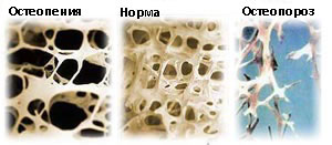 Остеопения, като ранен прекурсор на остеопорозата: как да се лекува и диагностицира?