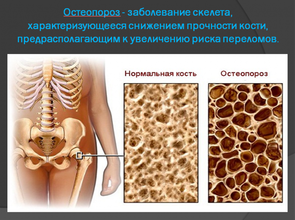 Остеопения на гръбначния стълб и шийката на бедрената кост