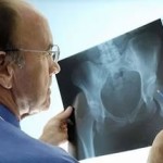 Остеопороза на тазобедрената става: симптоми, лечение и профилактика