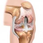 Остеопороза на коляното: Симптоми и лечение на коляното