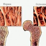 Остеопороза на коляното: Симптоми и лечение на коляното