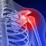 Остеопороза на раменната става: симптоми и лечение на рамото