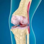 Патолофеморална артроза на колянната става 1 и 2 градуса: лечение на синдрома на болката