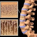 Периарстикуларна и системна остеопороза: симптоми и лечение