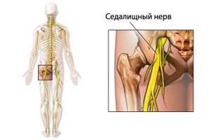 Прилепване на нервите в крака - когато болката стреля във всички посоки