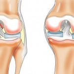 Посттравматичен артрит: симптоми и лечение на травматичен артрит на колянната става