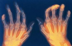 Предотвратяване на артрит - как да се спасят здравите стави преди старостта