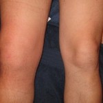 Гнойни дискове: симптоми и лечение на колянната става