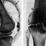 Гнойни дискове: симптоми и лечение на колянната става