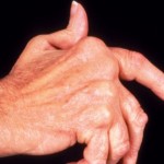 Ревматоиден артрит: причини при деца и възрастни
