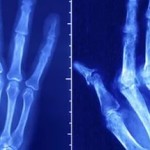 Ревматоиден артрит: диференциална диагноза и диагностика