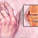 Ревматоиден артрит: как и какво да лекува ставите