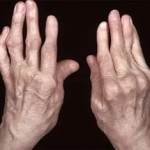 Ревматоиден артрит: как и какво да лекува ставите
