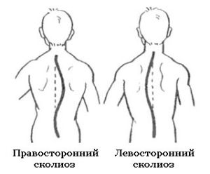 Дясна сколиоза на цервикалната, гръдната и лумбалната част на гръбначния стълб