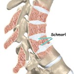 Широлната херния в лумбалната част на гръбначния стълб: симптоми и лечение