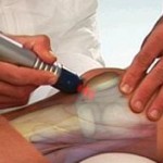 Терапия с Shockwave: лечение на артроза на колянната става