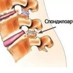 Спондилартроза на лумбалния гръбнак: причини, симптоми и лечение