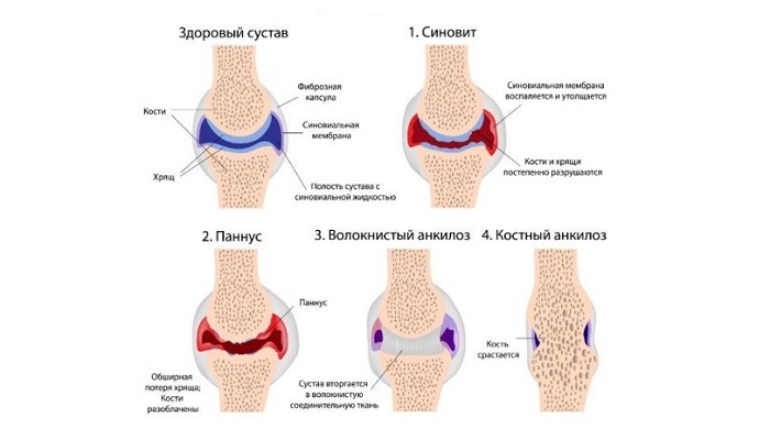 Ревматоиден артрит и болка в гърба
