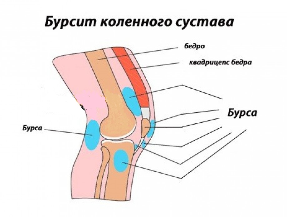 Симптоми и лечение на възпаление на торбичката за коляното