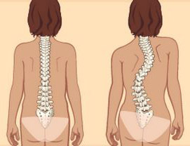 Симптоми и лечение на изпъкналости на дисковете на лумбалния гръбначен стълб