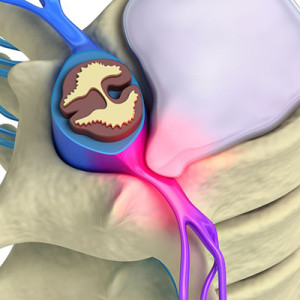 Симптоми и лечение на изпъкналости на дисковете на лумбалния гръбначен стълб