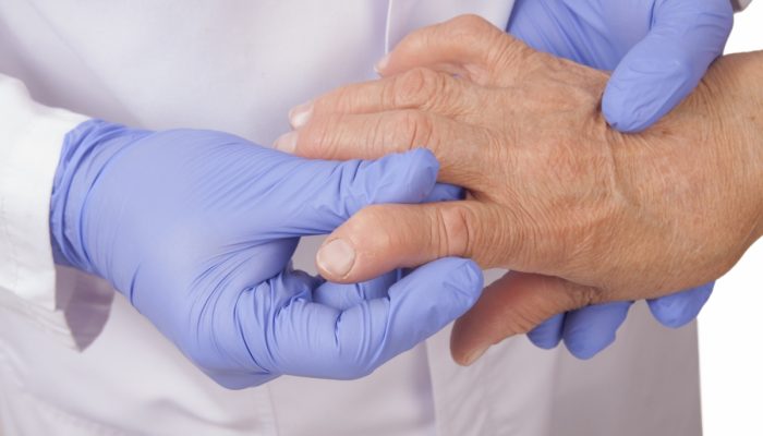 Симптоми и лечение на ревматоиден артрит