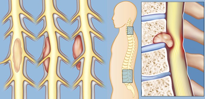 Симптоми на гръбначния стълб по отделение