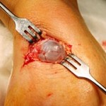 Синовиална киста (хигрома на крака): лечение и снимки